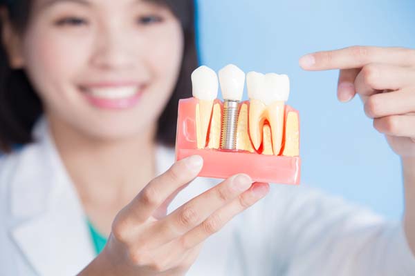 Reasons To Choose Dental Implants To Replace Missing Teeth